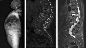 TeleRx, CT, and MRI of the spine of an 82-year-old female with multiple osteoporotic vertebral fractures in the dorsolumbar hinge L3, L2 with spinal canal invasion and D12 (Kümmell disease) with severe deformity.