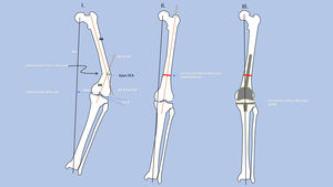 Pasos principales en el análisis de las deformidades articular y extraarticular (DEA) y planificación de corrección con técnica combinada (artroplastia total de rodilla [ATR] con osteotomía correctora [OC]). I. Análisis: determinación de eje mecánico (MA), su desviación (MAD), ejes anatómicos (AA), ángulo de convergencia articular (JLCA) y ápex de la DEA. II. Simulación de la corrección extraarticular con la OC en el ápex de la DEA. III. Corrección de la deformidad articular y fijación de la osteotomía con el implante articular (ATR).