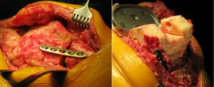 Imágenes intraoperatorias de osteotomía femoral distal biplanar con fijación temporal con placa LCP anteromedial.