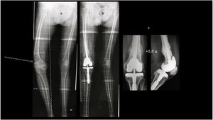 Varón de 68 años. A. Artrosis de rodilla derecha posfractura. Deformidad extraarticular (DEA) distal femoral de 24° en varo. Resección distal femoral necesaria excesiva que invade la inserción del ligamento lateral. DEA diafisaria tibial de 4° en valgo. B. Situación postoperatoria tras técnica combinada (ATR+OC). La leve lateralización del MA es debida a la DEA tibial que se consideró aceptable. C. 3,5 años postoperatorio.