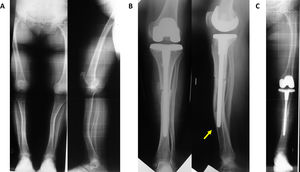 Mujer de 72 años. A. Artrosis de rodilla (OAR) izquierda. DEA diafisaria tibial en valgo de 18° secundaria a displasia ósea. B. Rx postopeatorias tras corrección con técnica combinada (ATR+osteotomía correctora). Efecto punta (flecha) por deformidad diafisaria distal en procurvatum no corregida. C. Telemetría AP a los 4 años de seguimiento.