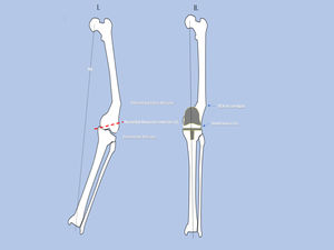 Corrección de la artrosis de rodilla +deformidad extrraarticular (DEA) severas mediante solo artroplastia total de rodilla (ATR). Desventajas respecto a técnica combinada (ATR+osteotomía correctora). I. Mayor resección ósea poniendo en riesgo la estabilidad previa. II. Ejes anatómicos no corregidos. Mayor dificultad o imposibilidad para utilizar vástagos en la prótesis.