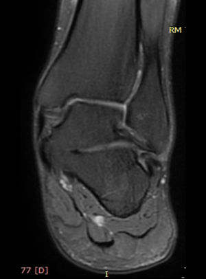 Corte coronal de la RM en secuencia STIR donde se observa una coalición talocalcánea ósea.