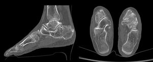 Cortes sagitales y axiales de la TAC donde se observa una coalición calcaneonavicular ósea.