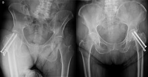 Se muestran dos ejemplos radiográficos de síntesis con TC que han sufrido necrosis avascular (izquierda) y acortamiento de cuello femoral y movilización del implante (derecha).