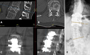 Fractura traumática en T12. A/B) TC preoperatoria. C/D) TC postoperatoria tras fijación del segmento corto con tornillos pediculares cementados y VBR con cementación de la placa terminal. E) Rayos X en bipedestación (plano coronal) durante el último seguimiento. La escoliosis lumbar permaneció constante. La paciente fue plenamente funcional, sin limitaciones de la vida diaria transcurridos cinco años postoperatorios.