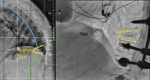 Standing kyphosis of 33.6°, which is reduced to 11.6° in the decubitus position, and is therefore considered flexible.