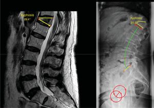 In the supine decubitus position, the MRI shows a kyphosis of 29.4°, which remains 31° on the standing X-ray. Therefore, it is considered a rigid kyphosis.