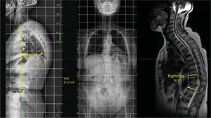 Case with multiple osteoporotic fractures resulting in a global kyphosis that is compensated and flexible in decubitus position.