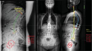 Illustration of a case with a stage 1 B C, showing that it compensates with a lumbar hyperlordosis mechanism (note a lumbar lordosis of 74° for a pelvic incidence of 54°). The patient was treated with a decancellation osteotomy and short instrumentation and normalisation of the lumbar hyperlordosis is observed on the 5-year postoperative control X-ray.