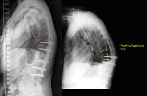 Complication during follow-up of a patient with a short arthrodesis after double-approach surgery: proximal adjacent level syndrome.