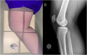 Posición del paciente y radiografía lateral según el protocolo institucional para la toma de las imágenes evaluadas.