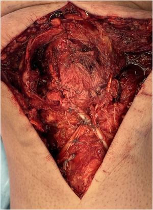 Aumentación realizada utilizando un autoinjerto (semitendinoso) pasando un lazo en forma de 8 a través del túnel transversal patelar, y en la tuberosidad tibial anterior utilizando la técnica descrita por Sundararajan et al.13.