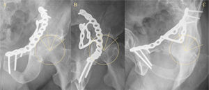 RX postoperatoria de un varón de 67 años tras la fijación de una fractura acetabular utilizando una placa suprapectínea. La WBD de 90̊ se traza comenzando en el borde libre del acetábulo y se divide en 3 segmentos equidistantes de 30̊ (medial, central y lateral). Se utiliza una circunferencia adaptada a la superficie articular como guía para medir las malreducciones en separación y escalón. También se registra la superposición de la placa sobre la línea articular. A) Proyección AP. Sin interferencia o malreducción. B) Proyección alar. Interferencia de la placa en los segmentos medial y central. No hay desplazamientos significativos del WBD. C) Proyección obturatriz. Interferencia sólo en el segmento medial. Tampoco se observan desplazamientos residuales. La calidad de la reducción se considera anatómica, pero 3 de los 9 segmentos están artefactados y no pueden ser correctamente evaluados.