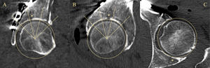 TC postoperatoria del mismo varón de 67 años. Al igual que en RX, la WBD de 90̊ se define y divide en 3 segmentos de 30̊. En esta ocasión, el ángulo de 90̊ se enfrenta a la cúpula en dirección completamente vertical al plano del examen. También se adapta una circunferencia a la superficie articular, que se utiliza como guía para medir las malreducciones en separación y escalón. A) Corte coronal. Segmentos medial, central y lateral. Desplazamiento principal en el segmento central, con un espacio de 2,6mm. B) Corte sagital. Segmentos anterior, central y posterior. Espacio de 1,8mm, también en el segmento central. C) Corte axial. Escalón de 0,7mm en la pared posterior. El * indica el área de máximo desplazamiento residual. La calidad de la reducción se considera imperfecta. Todos los segmentos han sido evaluados con claridad.