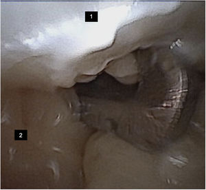 Endoscopic view of deep transverse metatarsal ligament (DTML) section. (1) Deep transverse metatarsal ligament. (2) Lumbrical muscle at risk.