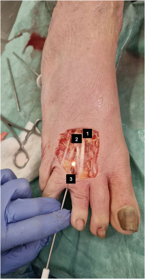 Dissection performed after each procedure. (1) Extensor digitorum longus. (2) Extensor digitorum brevis. (3) Dorsal view of the intermetatarsal space.