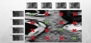 Esquema visual de la técnica de canalización pedicular «hundir la flota».