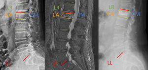 Rx PreQx; RM PreQx; Rx PostQx: A. Altura CA PreQx: 7mm; B. Altura CM PreQx: 13mm; C. Cifosis PreQx: 28,8°. AA. Altura CA post- Qx: 13mm; BB. Altura CM postQx: 18mm; CC. Cifosis postQX: 22,9.