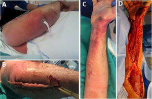 A) Bursitis olecraniana tras picadura de insecto (picadura de avispa). B) Desbridamiento primario. C) Placas cutáneas eritematosas tras desbridamiento. D) Desbridamiento radical tras empeoramiento clínico.