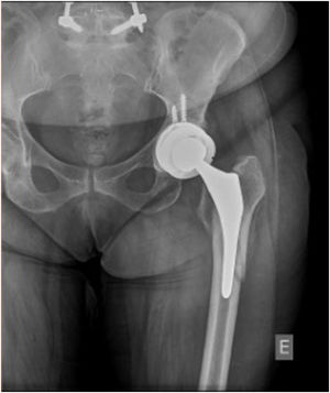 Imagen radiográfica anteroposterior de una fractura periprotésica de tipo B2 de Vancouver.