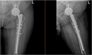 Imágenes radiográficas anteroposterior y lateral de una fractura periprotésica tratada con vástago cónico estriado no cementado.