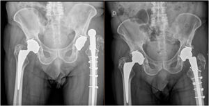 Imagen radiográfica anteroposterior de vástago para revisión de luxación con fractura de trocánter mayor y reducción cerrada subsiguiente.