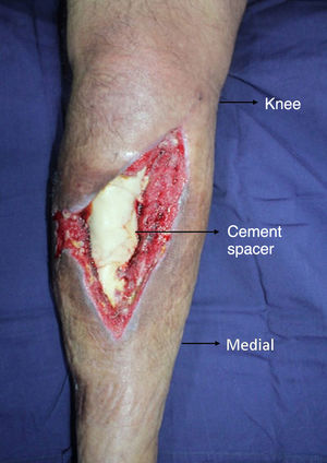 40-Year-old male patient with coverage defect in medial and proximal third of the leg, open GIIIB with critical bone defect.