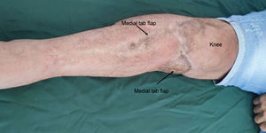 Healed flap and skin grafts at 6 months of patient follow-up.