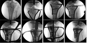 Fracture reduction sequence and subsequent treatment with plates and then nails.