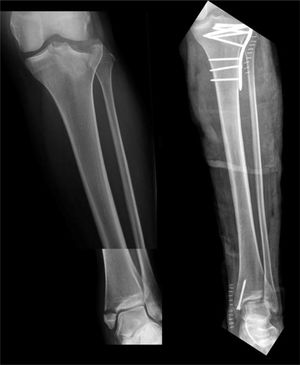 Fracture of Group 1 with treatment performed with plates and cannulated screws.