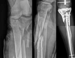 Fracture of Group 2 treated with plates and intramedullary rod.