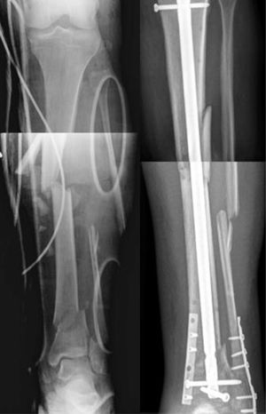 Fracture of Group 3 treated with plates and intramedullary rod.