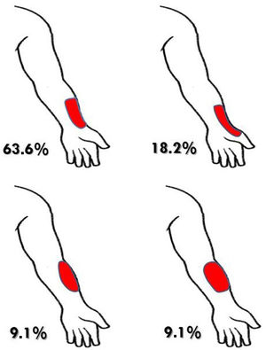 Areas of sensory involvement described by our patients. Proportion of patients showing each pattern.