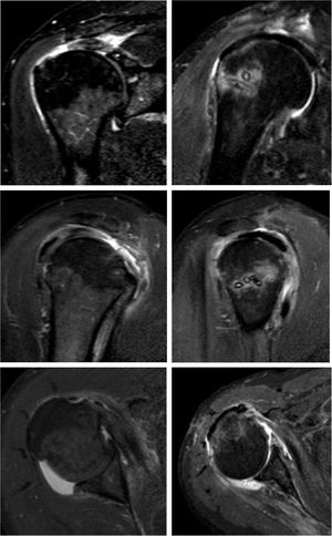 Resultado de imágenes de aloinjerto de Aquiles (AA). Resultado postoperatorio de reconstrucción capsular superior (RCS) con AA. A y B. Se muestran imágenes preoperatorias de resonancia magnética nueclear (RMN) con una lesión masiva e irreparable. Cy D. Imágenes postoperatorias de RMN, pasados 2 años de la reconstrucción con AA.