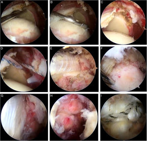 Resultado intraoperatorio con aloinjerto de Aquiles (AA). Resultado final intraoperatorio de una reconstrucción capsular superior (RCS) con AA. A y B. Mediciones intraoperatorias para la confección del aloinjerto de Aquiles. C. Preparación de la glena en las posiciones de las 11 y las 13 horas para la colocación de los anclajes. D. Colocación de los anclajes con doble sutura. E. Deslizamiento del aloinjerto mediante el sistema de doble polea. F. Fijación lateral en la huella de inserción del supraespinoso. G. Visualización del aloinjerto fijado y del manguito posterosuperior remanente. H. Reparación parcial del manguito posterosuperior. I. Cobertura completa de la cabeza humeral con el AA.