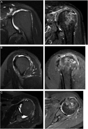 Resultado de imágenes con autoinjerto de porción larga del bíceps (PLB). El resultado postoperatorio de reconstrucción capsular superior con PLB se ilustra en las siguientes imágenes. A. Muestra un corte coronal de resonancia magnética nuclear (RMN) con una lesión Patte 3 del tendón del supraespinoso y su resultado postoperatorio con PLB. B. Corte sagital de RMN con una lesión posterosuperior del manguito rotador y su resolución con PLB. C. Lesión posterior del manguito rotador en un corte axial de RMN y su resolución con PLB. Todas las imágenes postoperatorias fueron tomadas a los 2 años después de la reconstrucción con PLB.