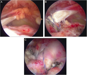 Técnica autoinjerto de porción larga del bíceps (PLB). A. Identificación de una lesión masiva del manguito rotador, visualizando claramente el área desprovista de los tendones supraespinoso e infraespinoso desde el portal lateral. B. Anclaje tendinoso de la PLB en el centro del troquíter. C. Reparación parcial del manguito remanente unido al PLB.