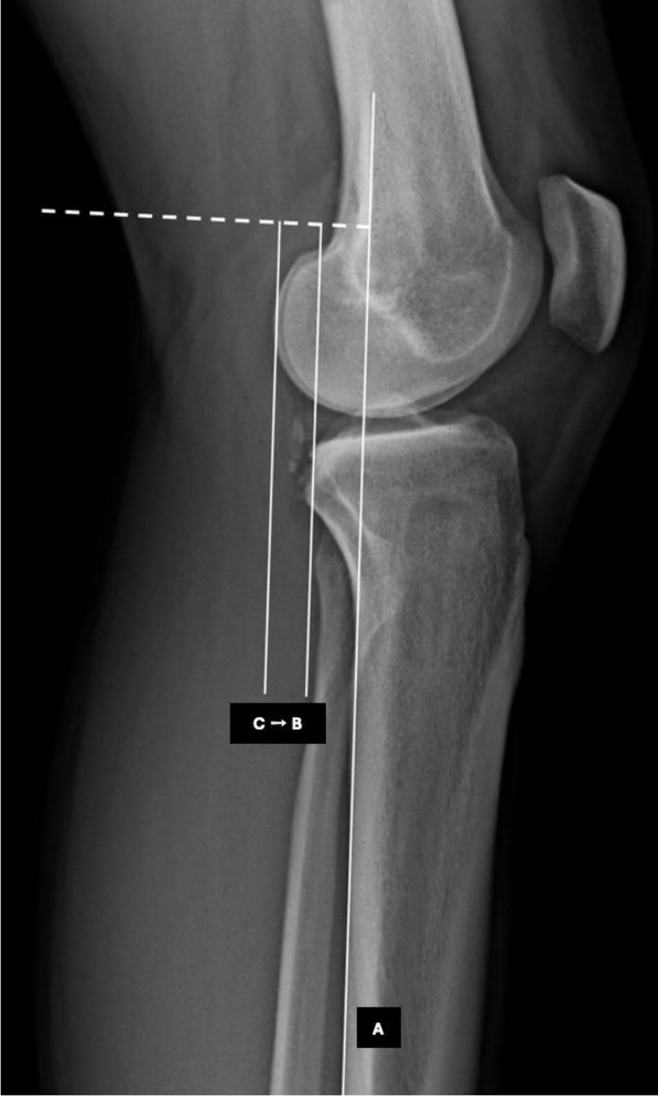 Tibia Linea Pendiente tibial en reconstrucción de ligamento cruzado anterior ...