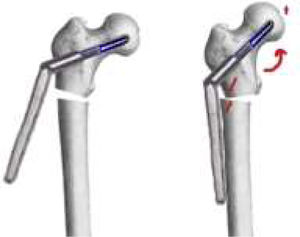 Compression between the proximal and the distal part of the nonunion is sought. Also, correction of valgus and lengthening of the leg.