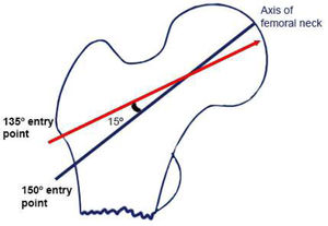 Diagram of entry points when using a 135 or 150° plate. The goal is to achieve a final position of the neck of about 150°.
