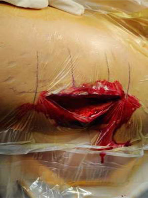 Lateral subvastus approach.