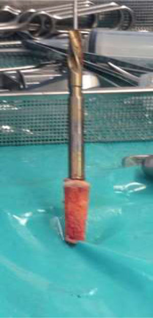 Bone graft prepared to be inserted. Shape it in a somewhat conic form for ease of introduction. The previous screw can be used as an impactor, as seen in the figure. Courtesy of Dr Nistal, Valladolid. Spain.