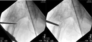 Chisel decompacting the nonunion area: (left) chisel introduced till medial cortex; (rigth) opening of the medial part of nonunion.