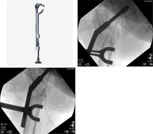 Lowman retractor tightened to reduce de nonunion, as previously planned. Upper left: Lowman retractor; upper right: Retractor attached to plate and bone before tightening; lower left: Retractor tightened and nonunion reduced.