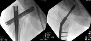 Left: nonunion just before operation. Right: Final fixation as seen in fluoroscopy with 6 holes, 150° DHS. Observe the over-valgus correction, and the increase in length.