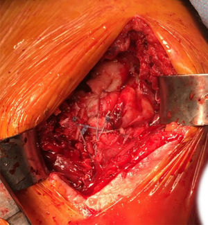 Técnica de reparación de tuberosidades.