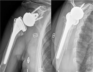 Radiografía frontal y de perfil de hombro. Se observa la ausencia de la tuberosidad en la radiografía frontal, pero se evidencia la consolidación en la radiografía axial.