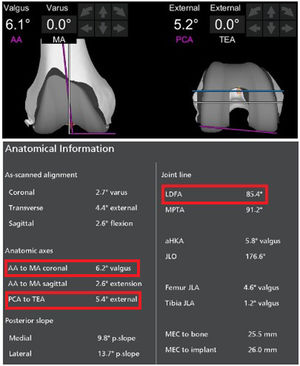 Pictures showing the preoperative hip–knee–ankle CT-based information obtained through the robotic system software. Individual anatomical landmarks can be measured for the coronal plane (AA [purple], MA [white], LDFA [purple]) and the axial plane (PCA [purple], TEA [white] and implant rotation [blue]). Patient-specific relationships can also be collected from the “Anatomical Information” screen (red).