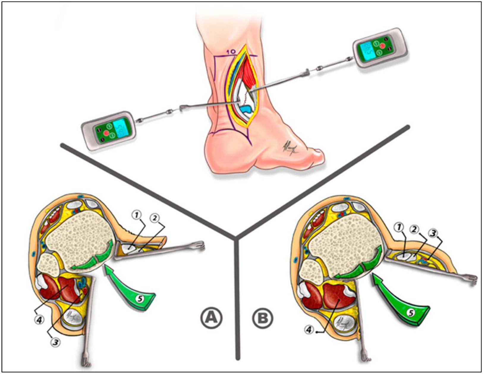 Comparison of applied tension to the postero-medial structures in the ...
